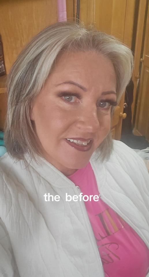 Before photo of a woman's teeth.