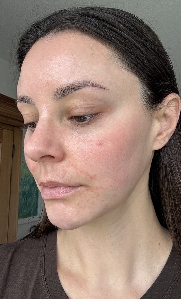 Emma North suffered from the skin condition perioral dermatitis, or what she calls the ‘beauty editor’s curse’, due to testing an abundance of free product samples, treatments and new wave facials for her job