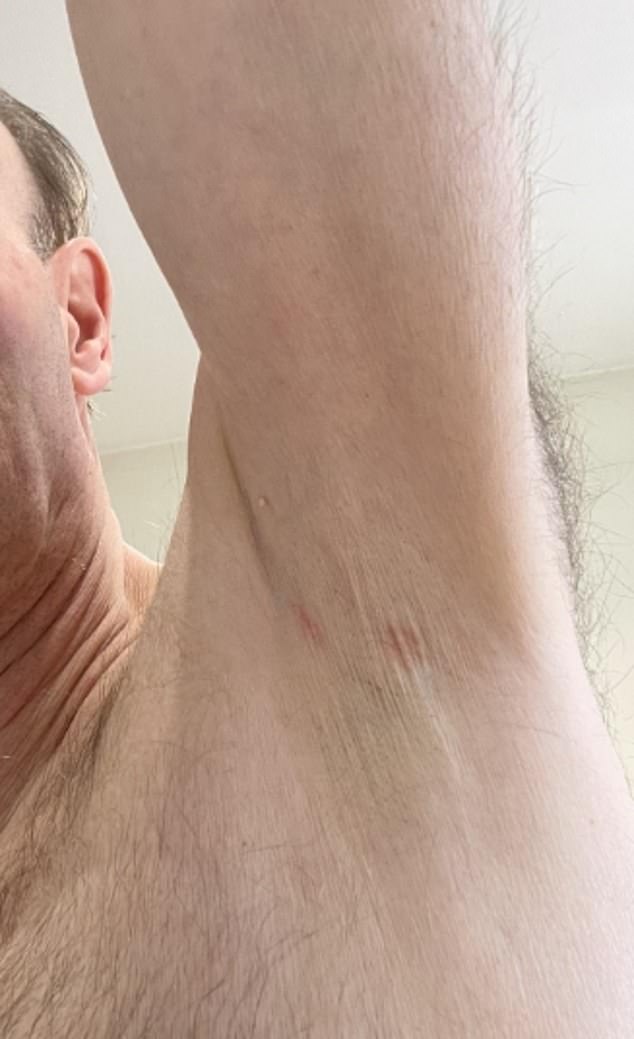 Men have now told the Daily Mail they too have required medical grade creams to treat the painful rashes and burning they suffered using the deodorants¿one even claimed to have lost all his armpit hair (pictured)