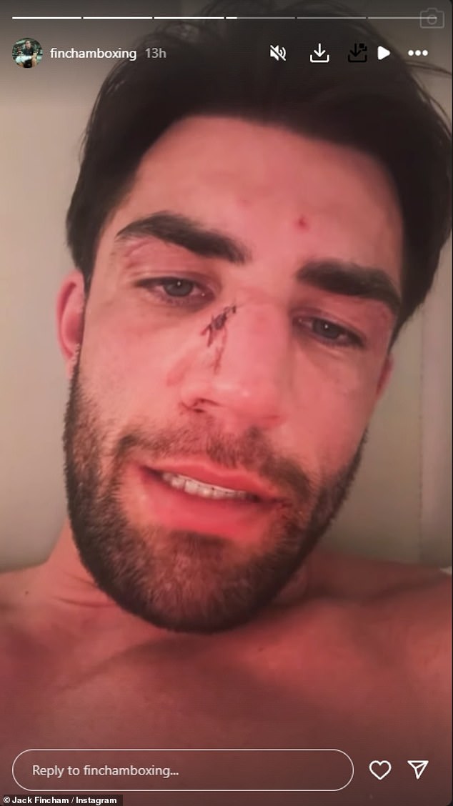 Jack revealed the extent of his injuries on Sunday by sharing a video of his bloodied face, after losing his bare-knuckle fight against Aaron Chalmers