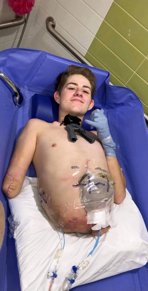 Loren Schauers in a hospital bed with an amputated arm and lower body, with medical tubes attached.