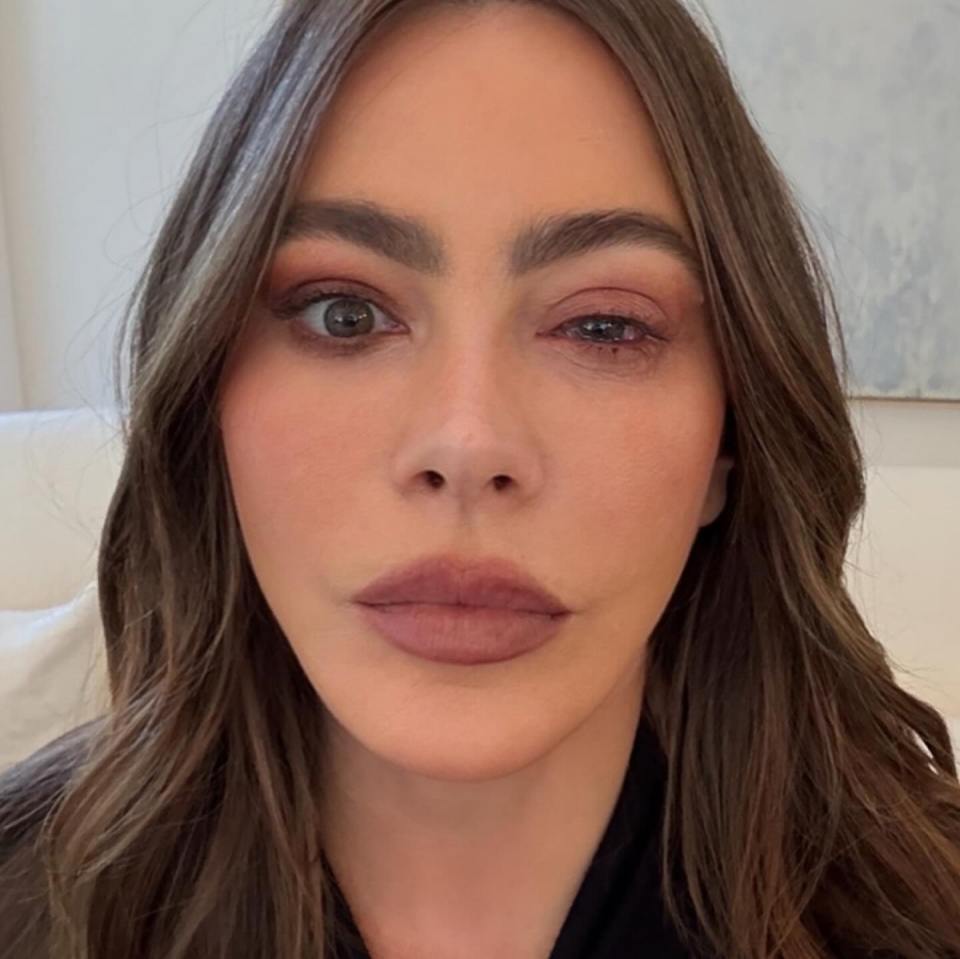 Sofia Vergara with a black eye.