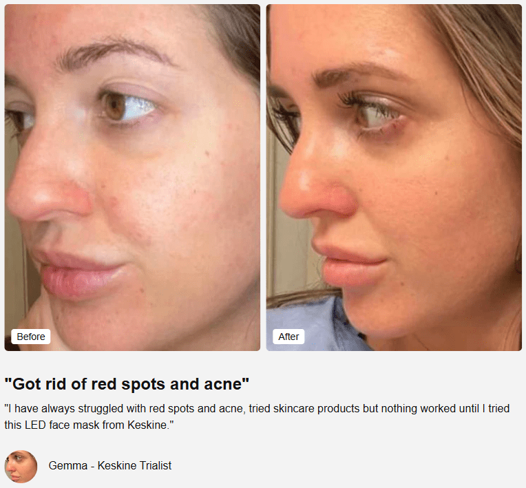 Collage of a woman's face before and after using an LED face mask.