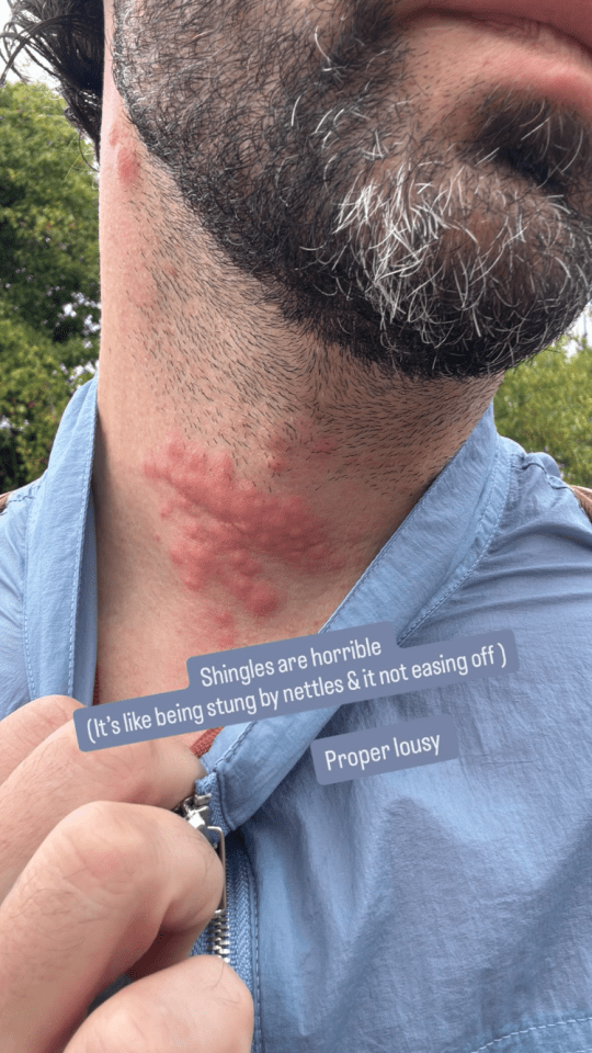 Close-up photo of a man's neck with a shingles rash.