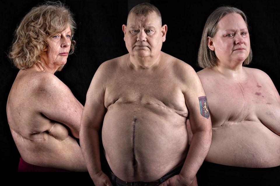 Three people, two women and one man, display their mastectomy scars.