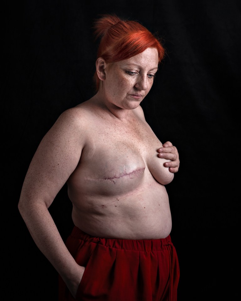 Woman with red hair and freckles, a mastectomy scar visible on her left breast.