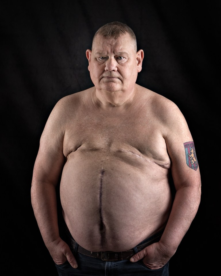 A man with visible scars from chest and abdominal surgery, and a tattoo on his left arm.