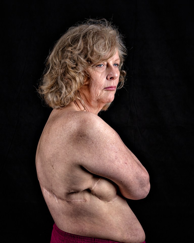A woman with a prominent mastectomy scar on her chest, looking away from the camera.