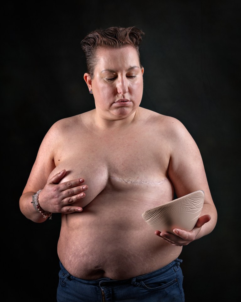 A woman holding a breast prosthesis while exposing her mastectomy scar and remaining breast.