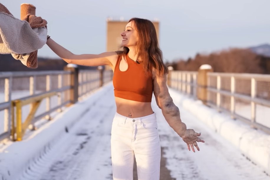 A young woman with one arm affected by a medical condition smiles while walking on a snowy path.