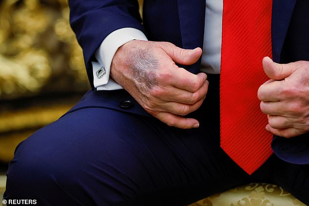 A bruise on a hand of Trump is seen during a meeting with South Korean President Lee Jae Myung at the Oval Office, at the White House, in Washington, D.C., U.S., August 25, 2025