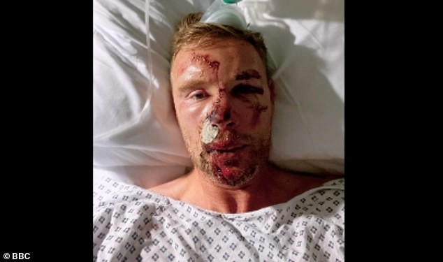 Freddie was left with serious facial injuries and several broken ribs after a near-fatal car crash when he was filming Top Gear alongside Paddy in December 202ry