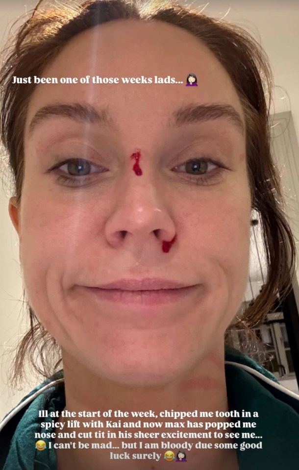 Vicky Pattison with blood on her nose and forehead.
