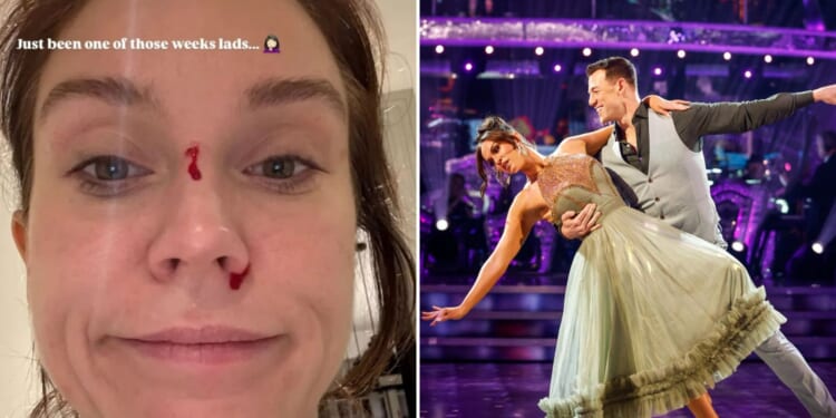 Vicky Pattison reveals bloodied face just hours before Strictly live show