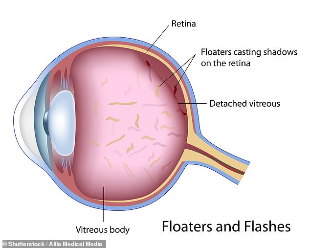 This graph above shows where floaters and flashes that you see actually are in the eye