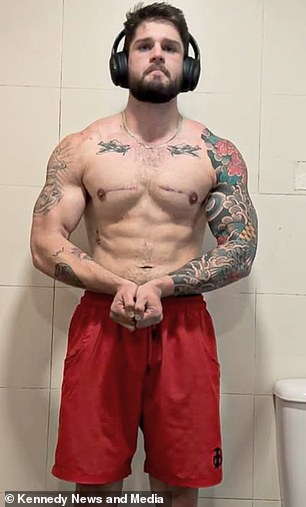 He had the tissue removed last year after he was diagnosed with gynaecomastia