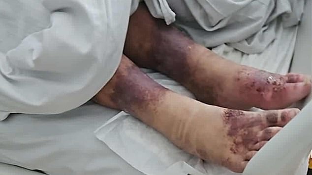 Police found the woman after neighbours reported a disturbance. They noticed injuries on her legs and took her to hospital, where she remains in critical condition