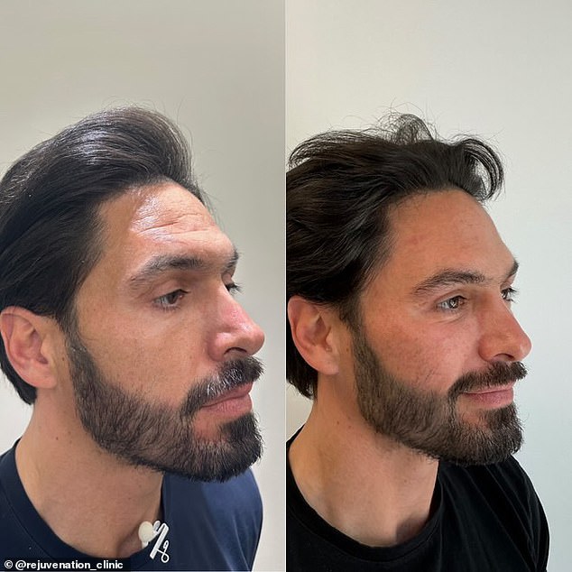 He has undergone a range of treatments including dermal fillers, chemical peels, Botox and Polynucleotides (more colloquially known as salmon sperm facials)