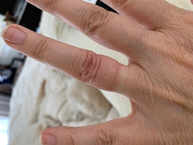 Denise remembers her wedding ring digging into her finger as a key moment in encouraging her to take control of her health