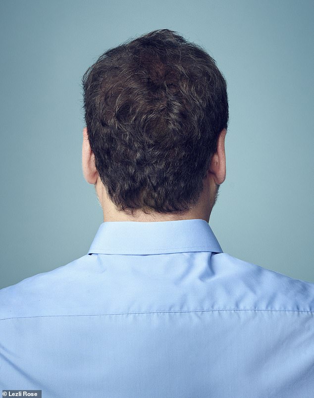 The back of Cornel's head after his hair transplant. He says: 'I feel I look good in pictures and am way more confident'