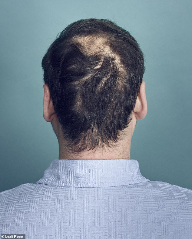 The back of Cornel's head before his transplant