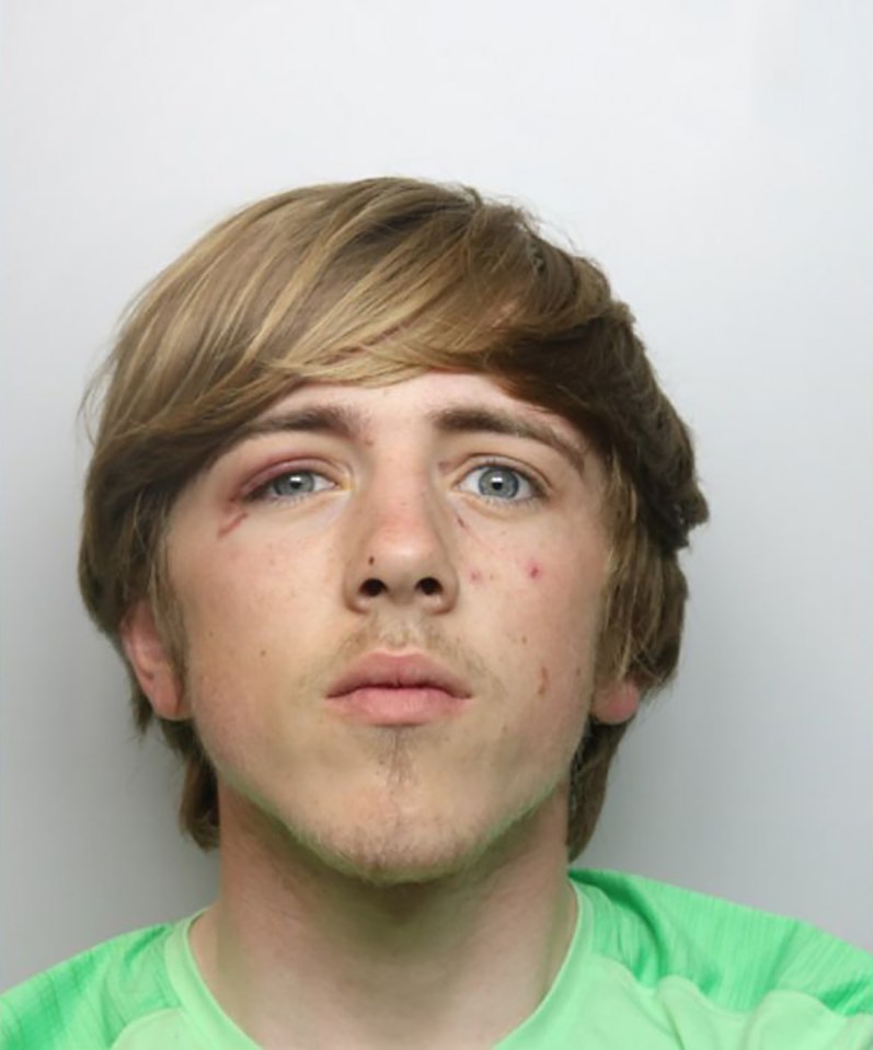 Layton Bowman, 20, with a black eye.