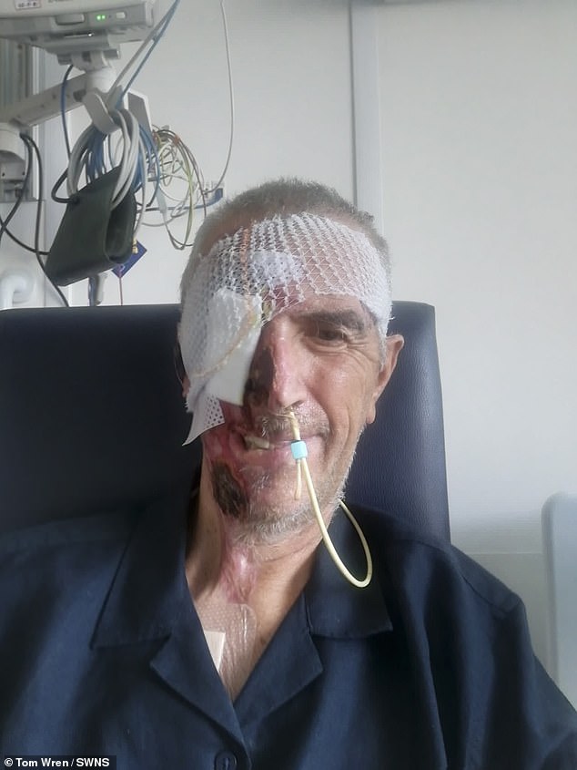 Mr Richards was left with third degree burns down one side of his face