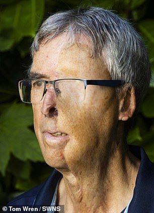 Before: Surgeons were forced to remove his eye and use a 'free flap' technique to reconstruct his face