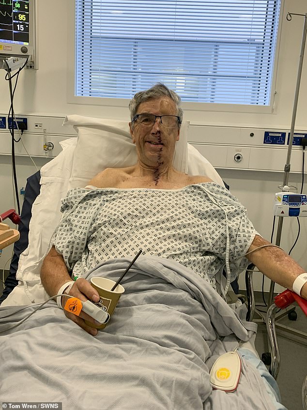 While Dave was recovering at the Bristol Royal Infirmary, he was given the chance to have a 3D printed prosthetic fitted