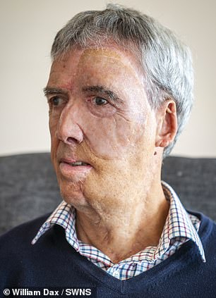 After: The prosthetic has given him a huge confidence boost