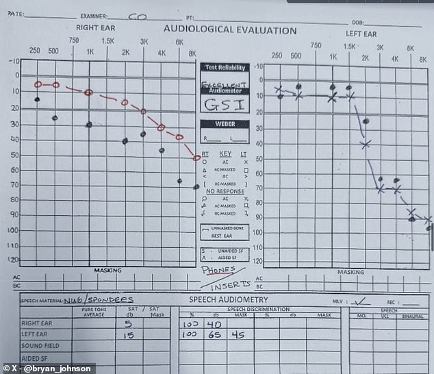 Johnson shared a photo of his recent hearing test results, which shows normal hearing in the right ear and significant high-frequency sensorineural hearing loss in the left ear