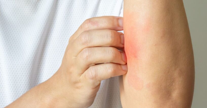 Ivermectin is now available in a cream that can be used to treat a variety of skin problems.