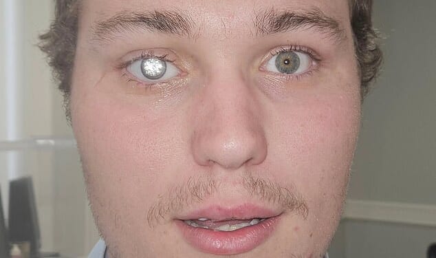 A jewellery store owner from Alabama has given himself an eye-catching look fit for a Bond villain after installing a two-carat diamond into his prosthetic eye