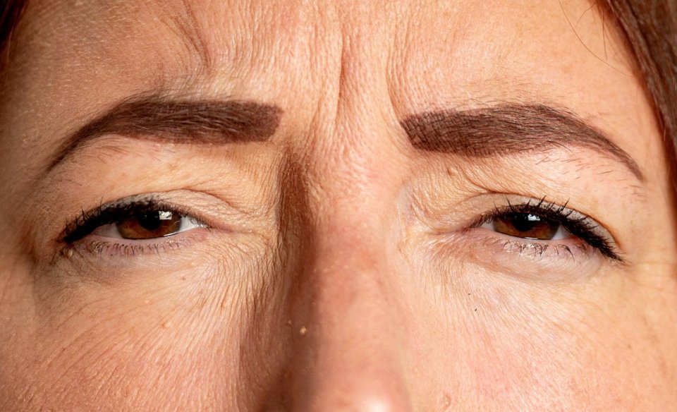 A person squinting, showing wrinkles around their eyes and on their forehead.