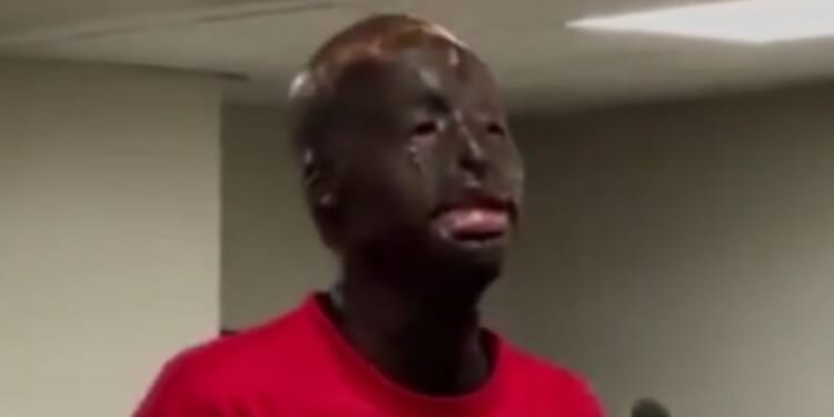 Zaquan Shaquez Jamison appears in court after being charged with murder, but he claims it is impossible for him to be the killer because his burns do not allow his hand to bend to pull the trigger.