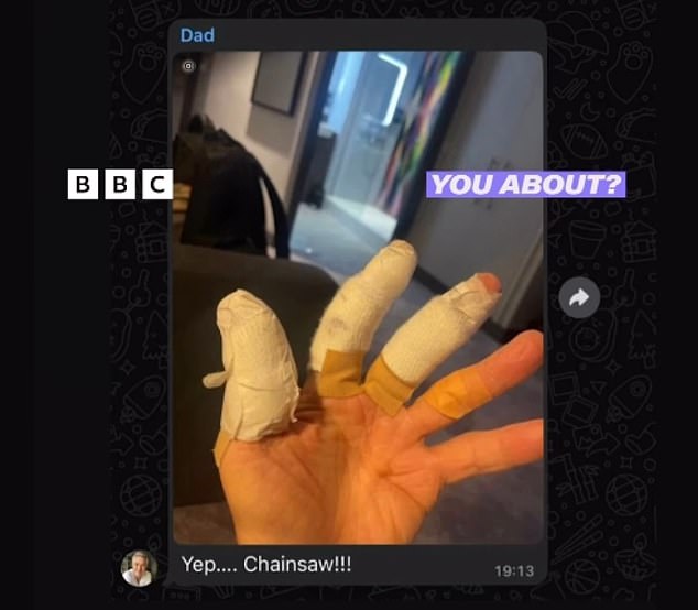 Roman Kemp revealed the picture sent by his father Martin of his injured hand