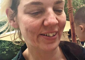 Dr Justine Hextall pictured before she made 11 lifestyle changes that had a dramatic impact on her skin