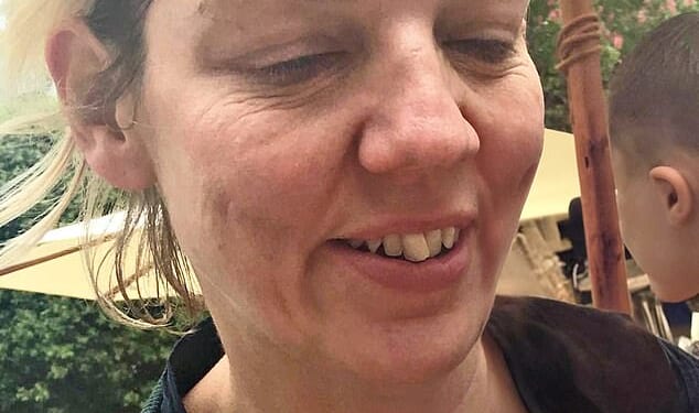 Dr Justine Hextall pictured before she made 11 lifestyle changes that had a dramatic impact on her skin