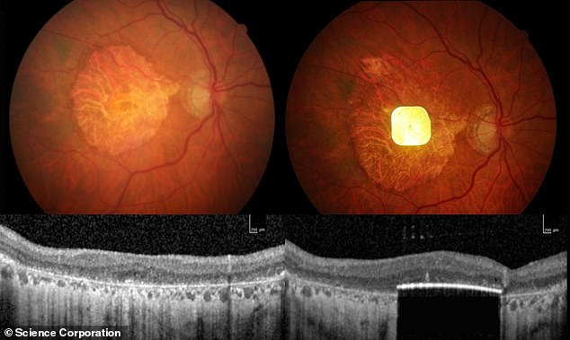 In trials, participants were able to read letters, numbers and words using the prosthetic vision system. Pictured, image of the electronic chip in a patient's eye