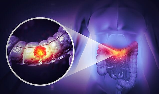 A top doctor has revealed a test which can reveal if you have a problem linked to colon cancer