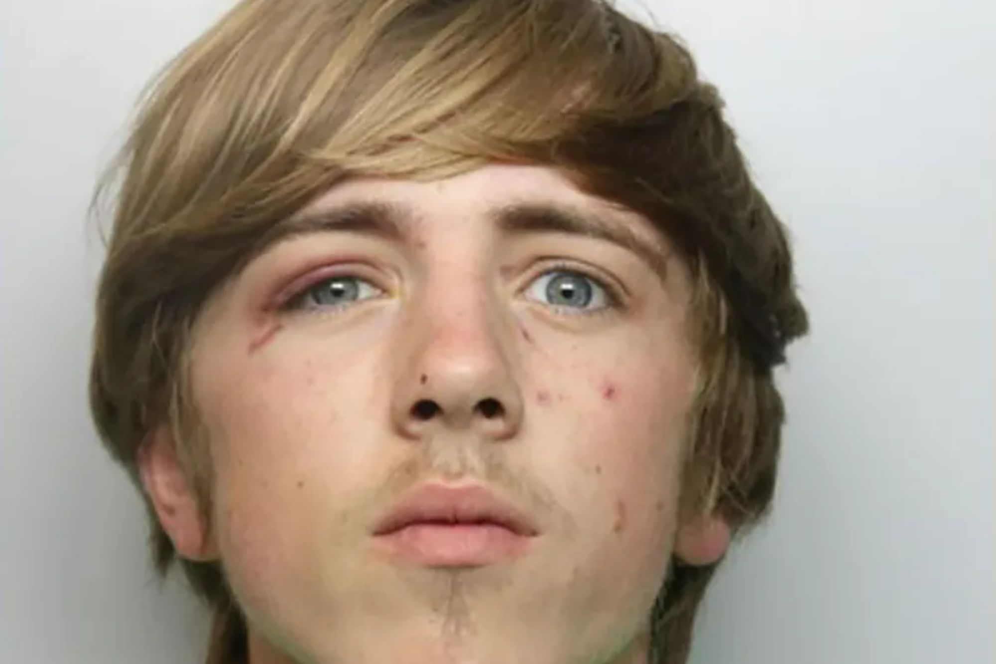 An image collage containing 1 images, Image 1 shows Layton Bowman, 20, with a black eye