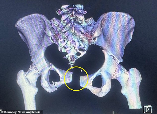 Pictured: A scan of Clarice's crushed pelvis following the horror car crash