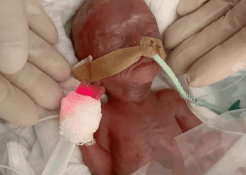 Incredibly tiny premature baby is born 16 WEEKS early weighing as much as two slices of bread