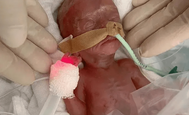 Incredibly tiny premature baby is born 16 WEEKS early weighing as much as two slices of bread