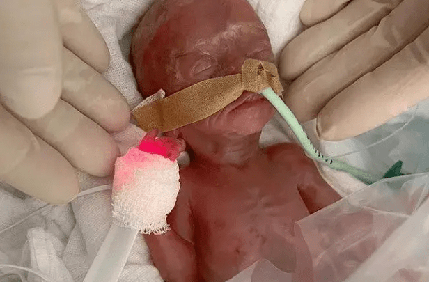 Incredibly tiny premature baby is born 16 WEEKS early weighing as much as two slices of bread