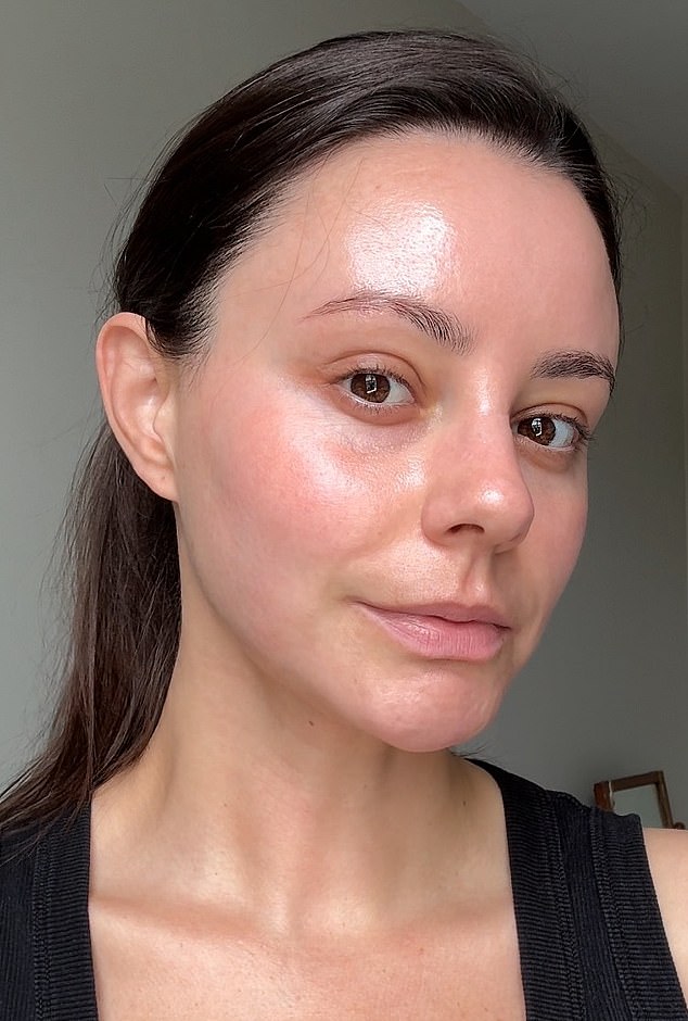 Emma following her course of Seriderm's DermaV laser, carried out by consultant dermatologist Dr Ellie Rashid at OneWelbeck Clinic in London