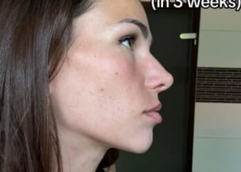 People ask if I got surgery to fix my sagging chin