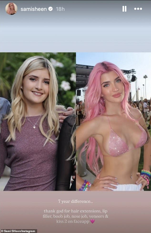 The OnlyFans model has had a boob job, nose job, veneers, Botox and fillers