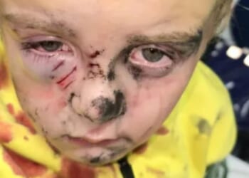Boy, 5, mauled by dog in park in front of horrified mum ‘who was sure it would kill him’