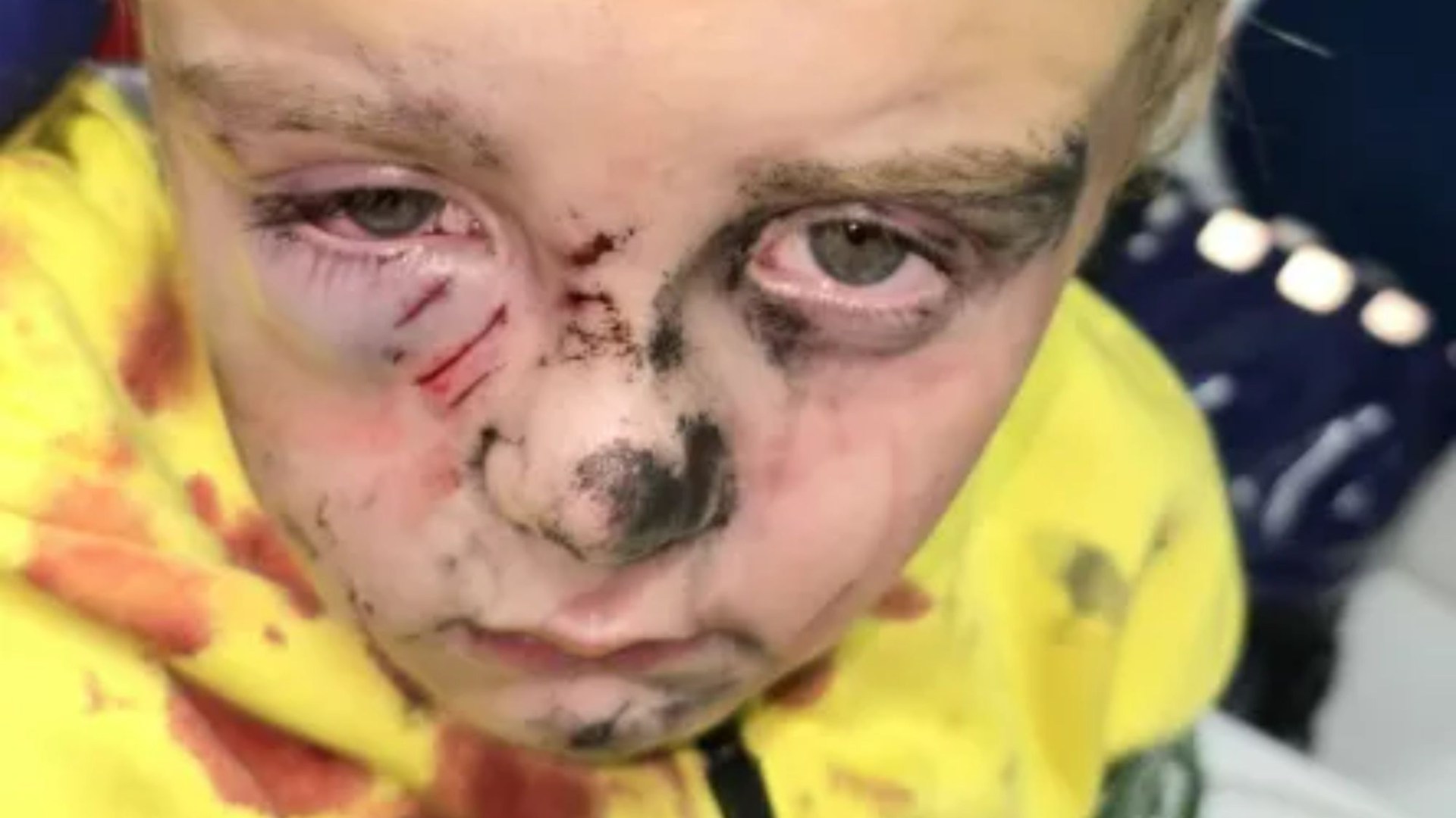 Boy, 5, mauled by dog in park in front of horrified mum ‘who was sure it would kill him’